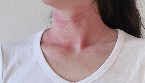 Level-Up Study | skin rashes